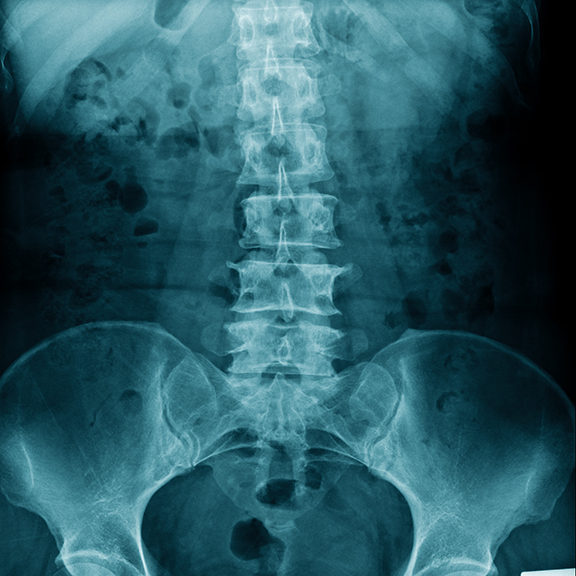 lumbar spinal stenosis image